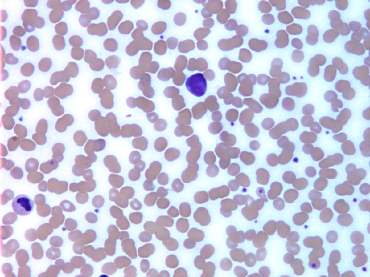 Peripheral blood showing circulating blast